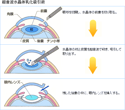 超音波水晶体乳化吸引術 眼球を切開し、水晶体の前嚢を切り取る　水晶体の核と皮質を超音波で砕き、吸引して取り出す。　残した後嚢の中に眼内レンズを挿入する